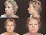 before facelift.jpg